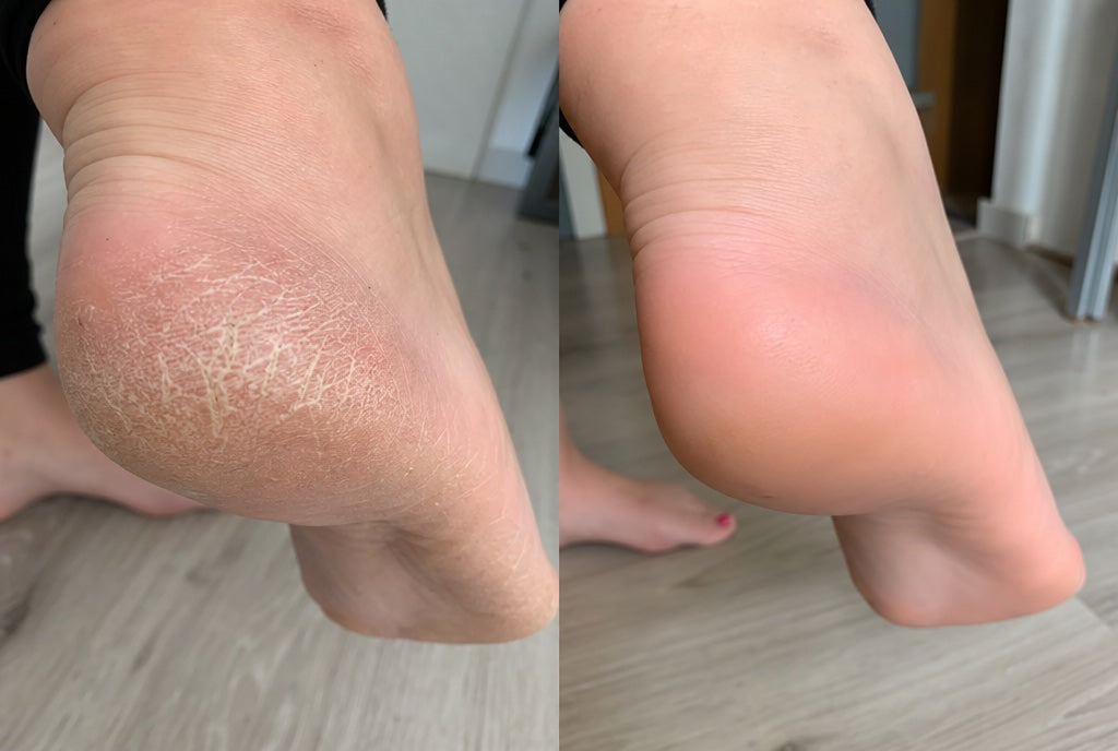 Foto di una cliente: tallone prima e dopo