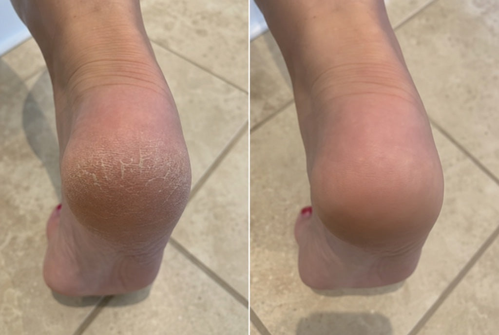 Foto di una cliente: tallone prima e dopo